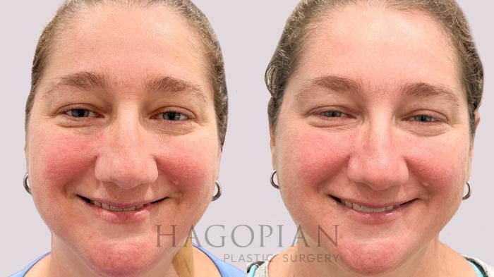 Before & After BOTOX® Cosmetic Case 202 Smile View in Atlanta, GA