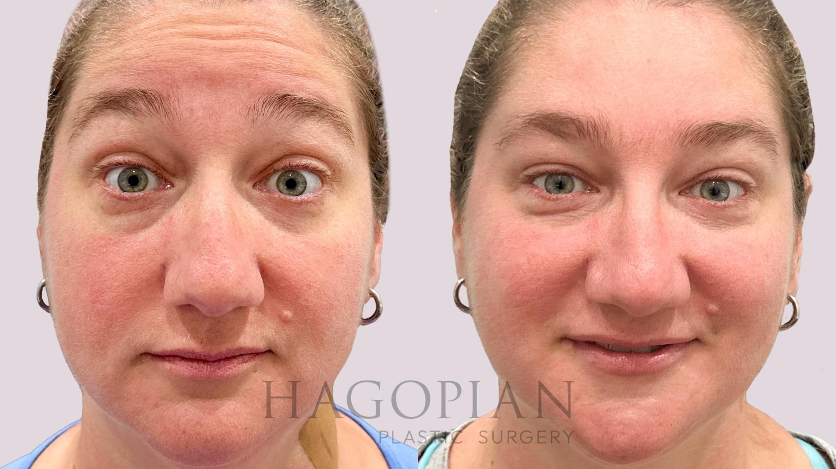 Before & After BOTOX® Cosmetic Case 202 Surprize View in Atlanta, GA