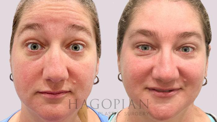 Before & After BOTOX® Cosmetic Case 202 Surprize View in Atlanta, GA