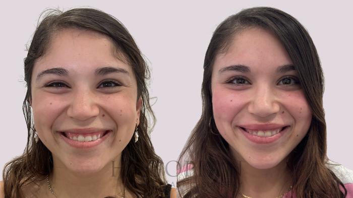 Before & After BOTOX® Cosmetic Case 211 Front View in Atlanta, GA