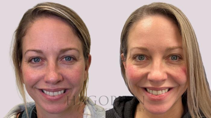 Before & After BOTOX® Cosmetic Case 212 Front View in Atlanta, GA