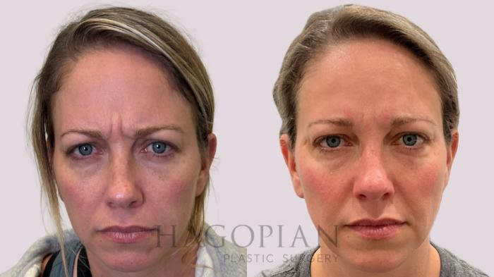 Before & After BOTOX® Cosmetic Case 212 Furrow  View in Atlanta, GA