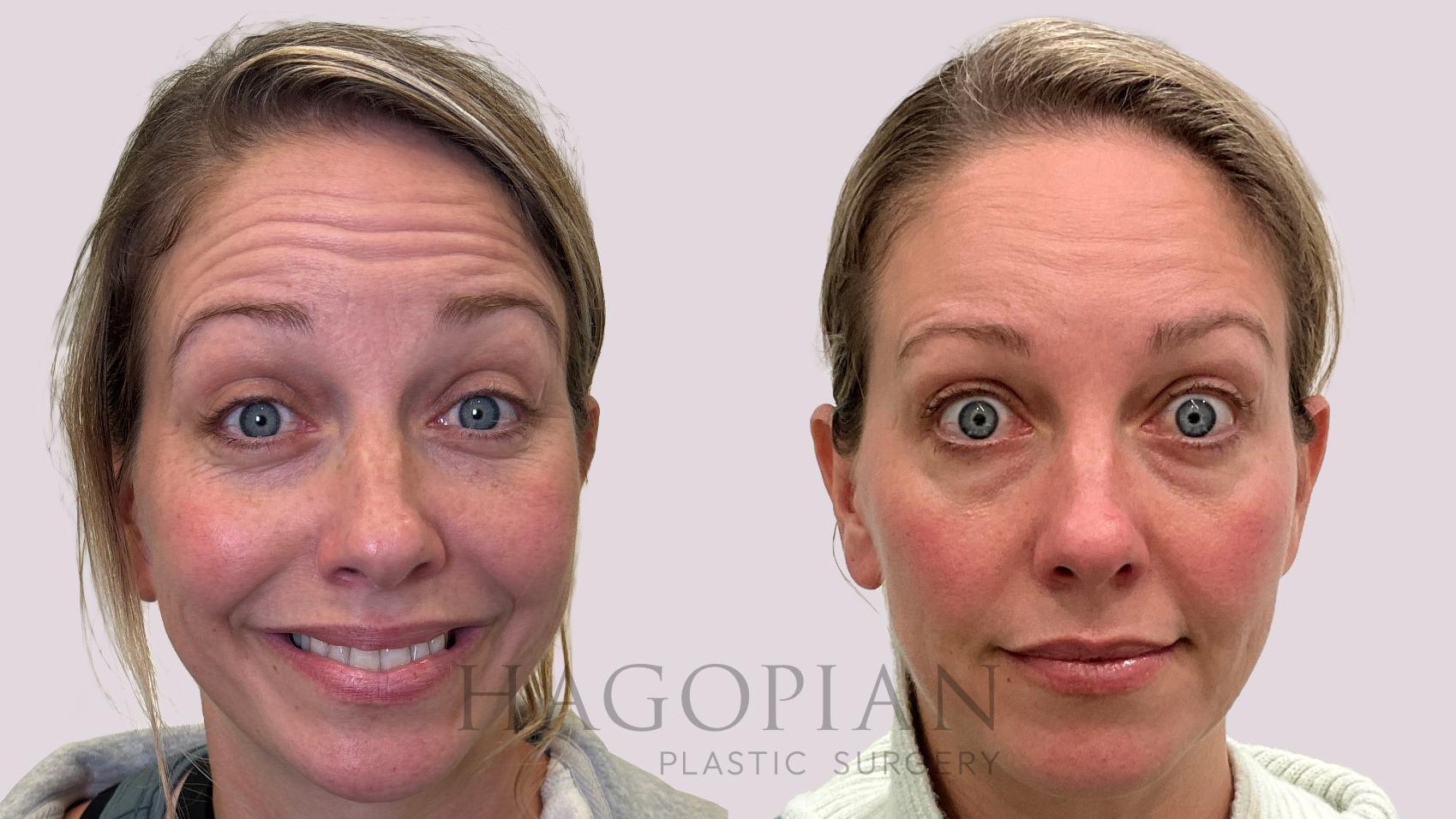 Before & After BOTOX® Cosmetic Case 212 surprise View in Atlanta, GA