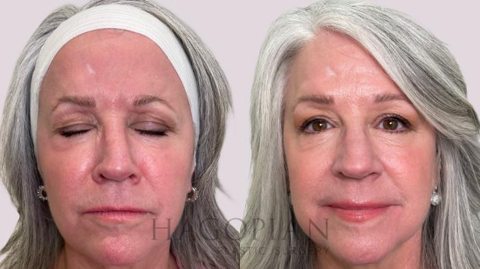 Before & After BOTOX® Cosmetic Case 213 Angry View in Atlanta, GA