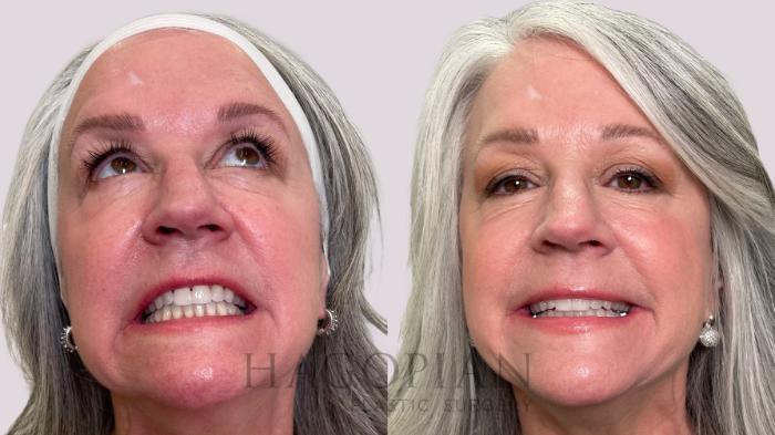 Before & After BOTOX® Cosmetic Case 213 Front View in Atlanta, GA
