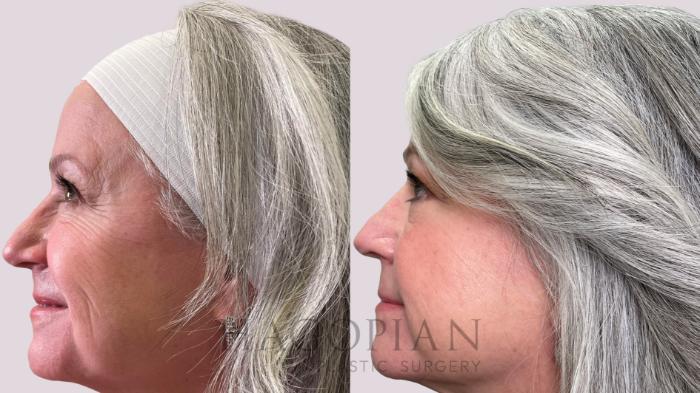 Before & After BOTOX® Cosmetic Case 213 Left Oblique View in Atlanta, GA