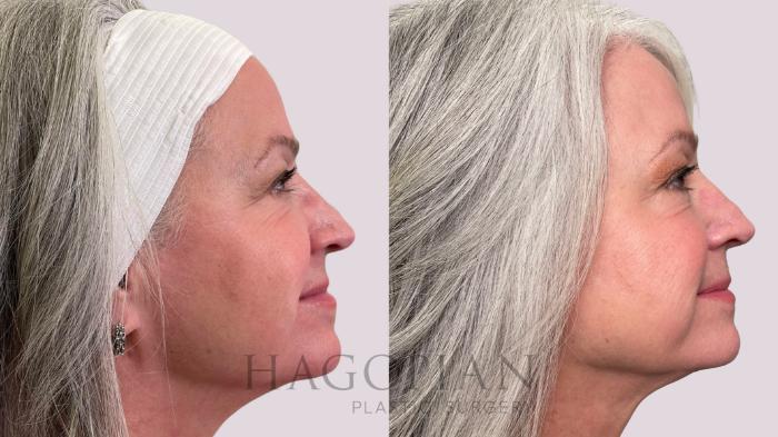 Before & After BOTOX® Cosmetic Case 213 Right Side View in Atlanta, GA