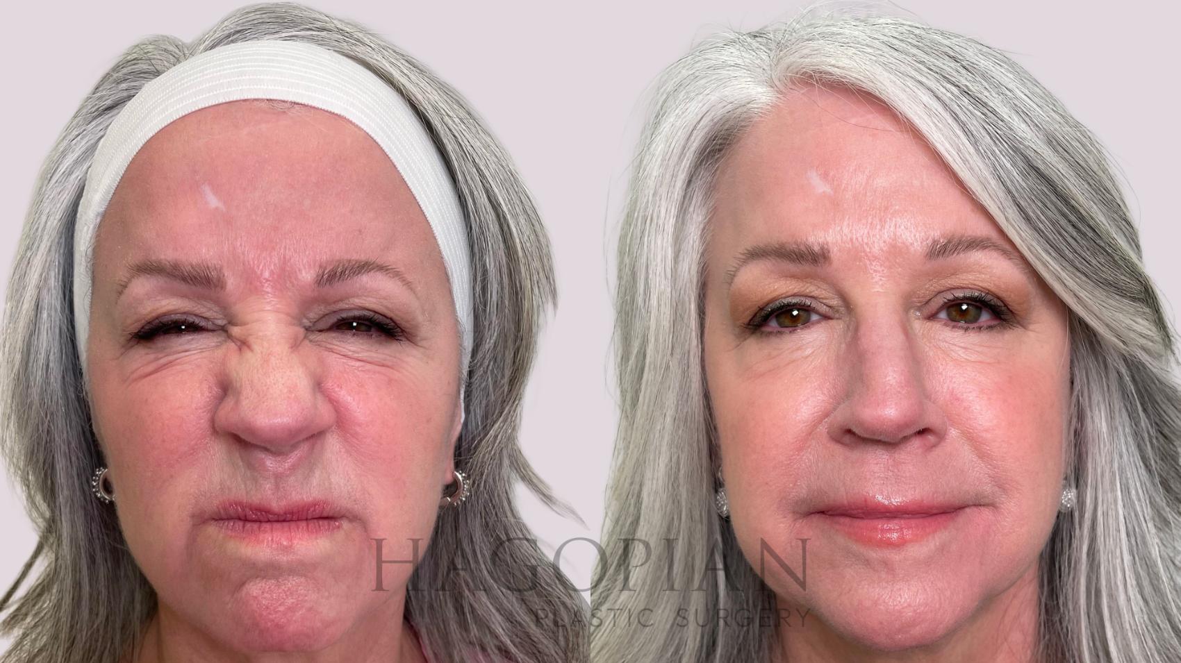 Before & After BOTOX® Cosmetic Case 213 Scrunch View in Atlanta, GA