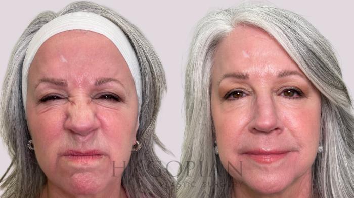 Before & After BOTOX® Cosmetic Case 213 Scrunch View in Atlanta, GA