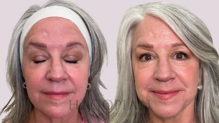 Before & After BOTOX® Cosmetic Case 213 surprise View in Atlanta, GA