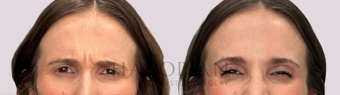 Before & After BOTOX® Cosmetic Case 275 grimace View in Atlanta, GA
