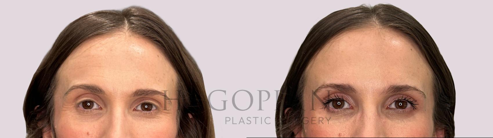 Before & After BOTOX® Cosmetic Case 275 rest View in Atlanta, GA