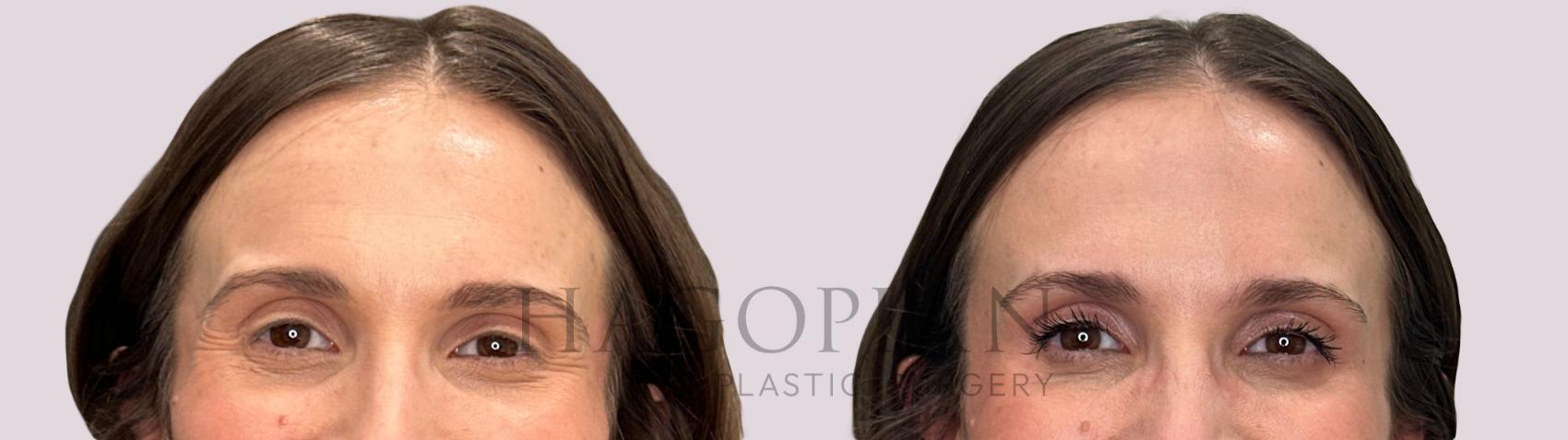Before & After BOTOX® Cosmetic Case 275 smile View in Atlanta, GA