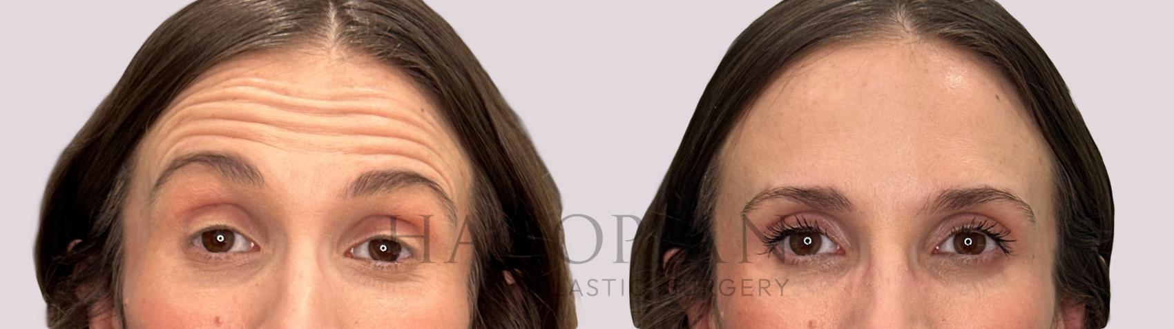Before & After BOTOX® Cosmetic Case 275 surprise View in Atlanta, GA
