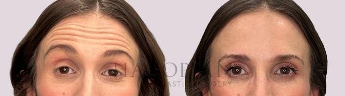Before & After BOTOX® Cosmetic Case 275 surprise View in Atlanta, GA