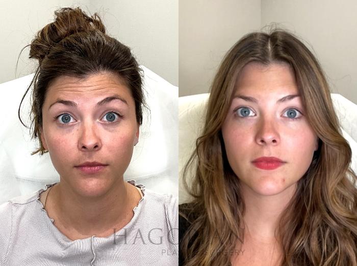 Before & After BOTOX® Cosmetic Case 68 Front View in Atlanta, GA
