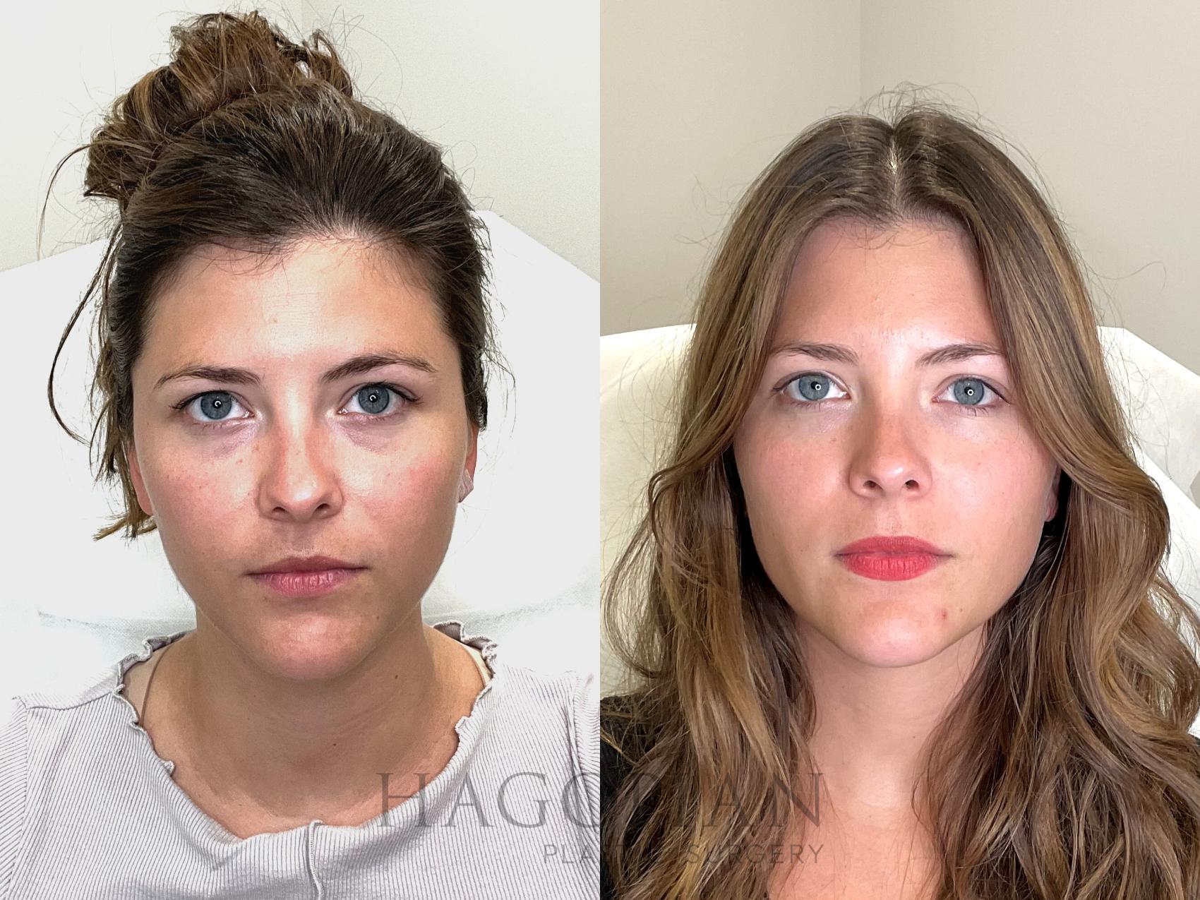 Before & After BOTOX® Cosmetic Case 68 relaxed View in Atlanta, GA