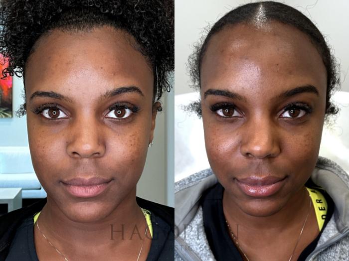 Before & After BOTOX® Cosmetic Case 69 Front View in Atlanta, GA