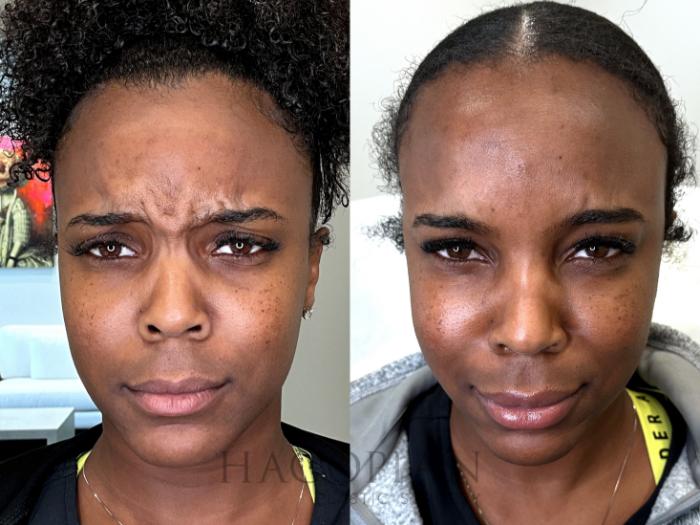 Before & After BOTOX® Cosmetic Case 69 Scrunched face View in Atlanta, GA