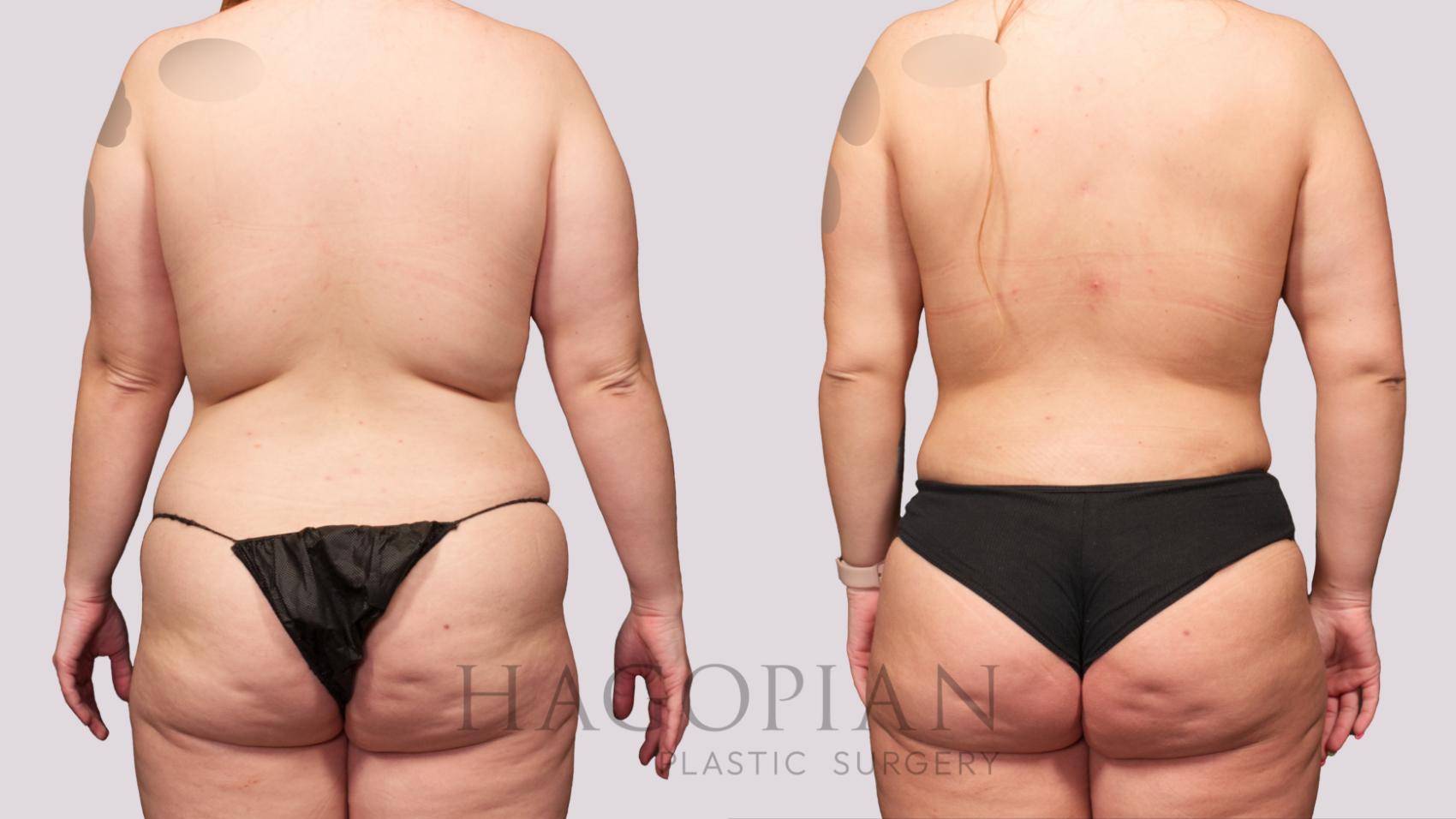 Before & After Brazilian Butt Lift Case 28 Back View in Atlanta, GA