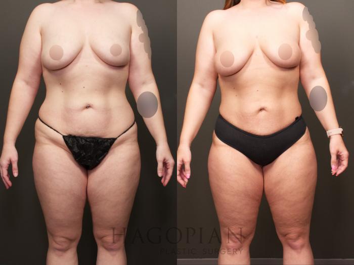 Before & After Brazilian Butt Lift Case 28 Front View in Atlanta, GA