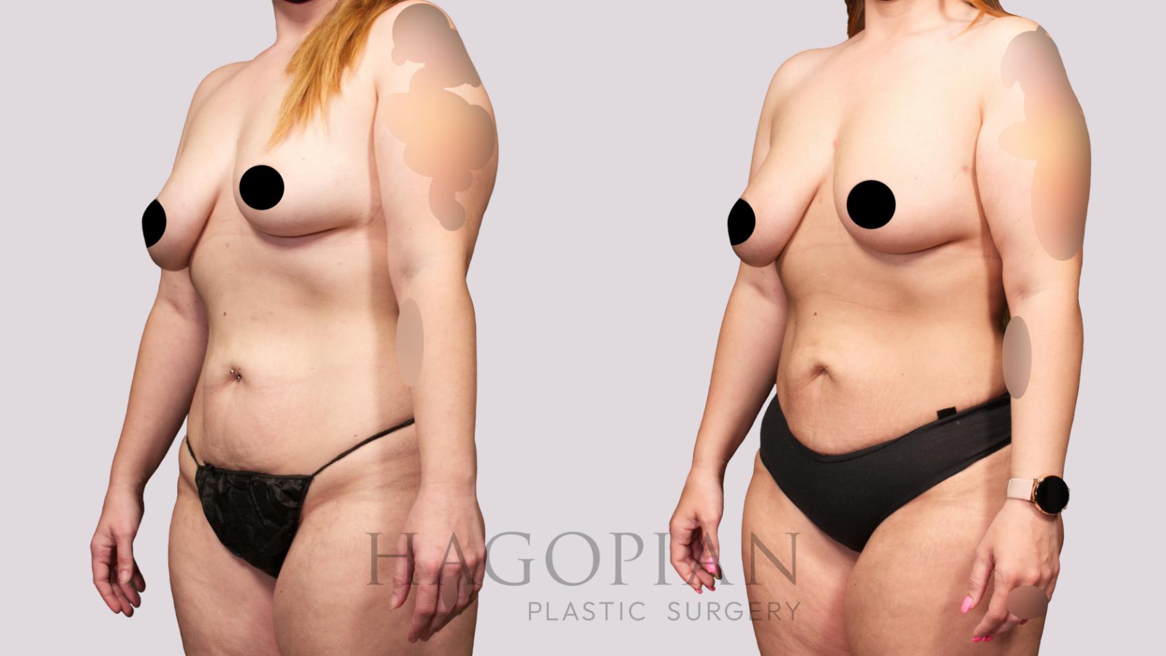 Before & After Brazilian Butt Lift Case 28 Left Oblique View in Atlanta, GA