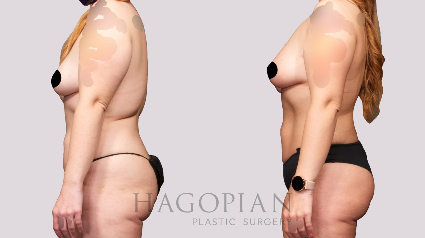 Before & After Brazilian Butt Lift Case 28 Left Side View in Atlanta, GA