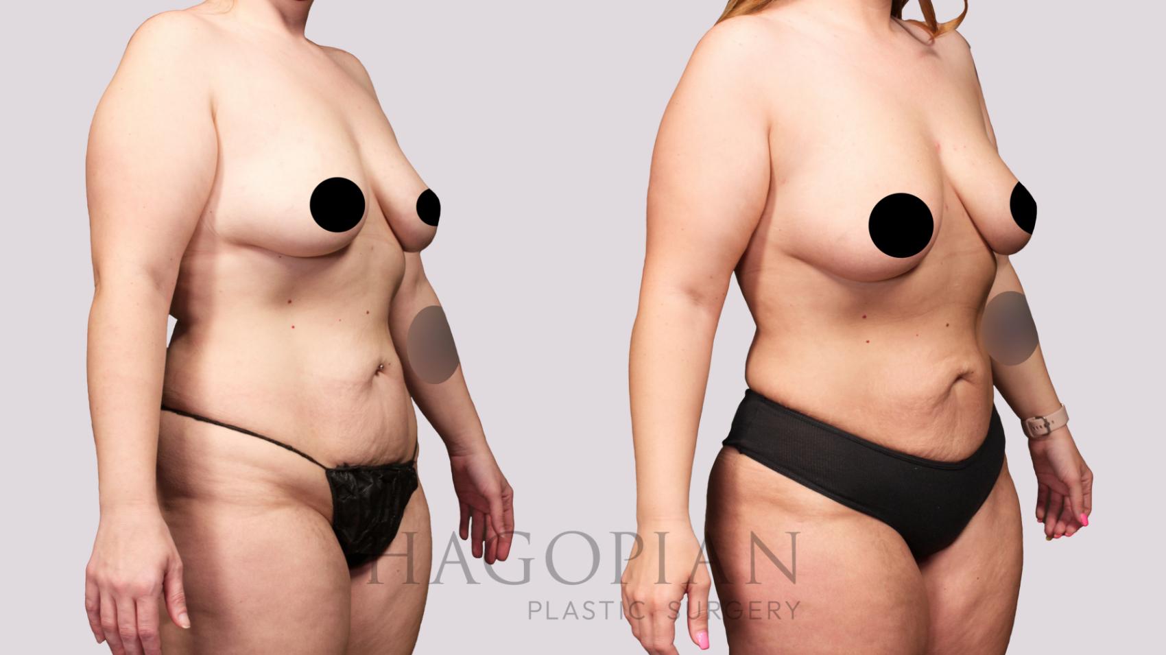 Before & After Brazilian Butt Lift Case 28 Right Oblique View in Atlanta, GA