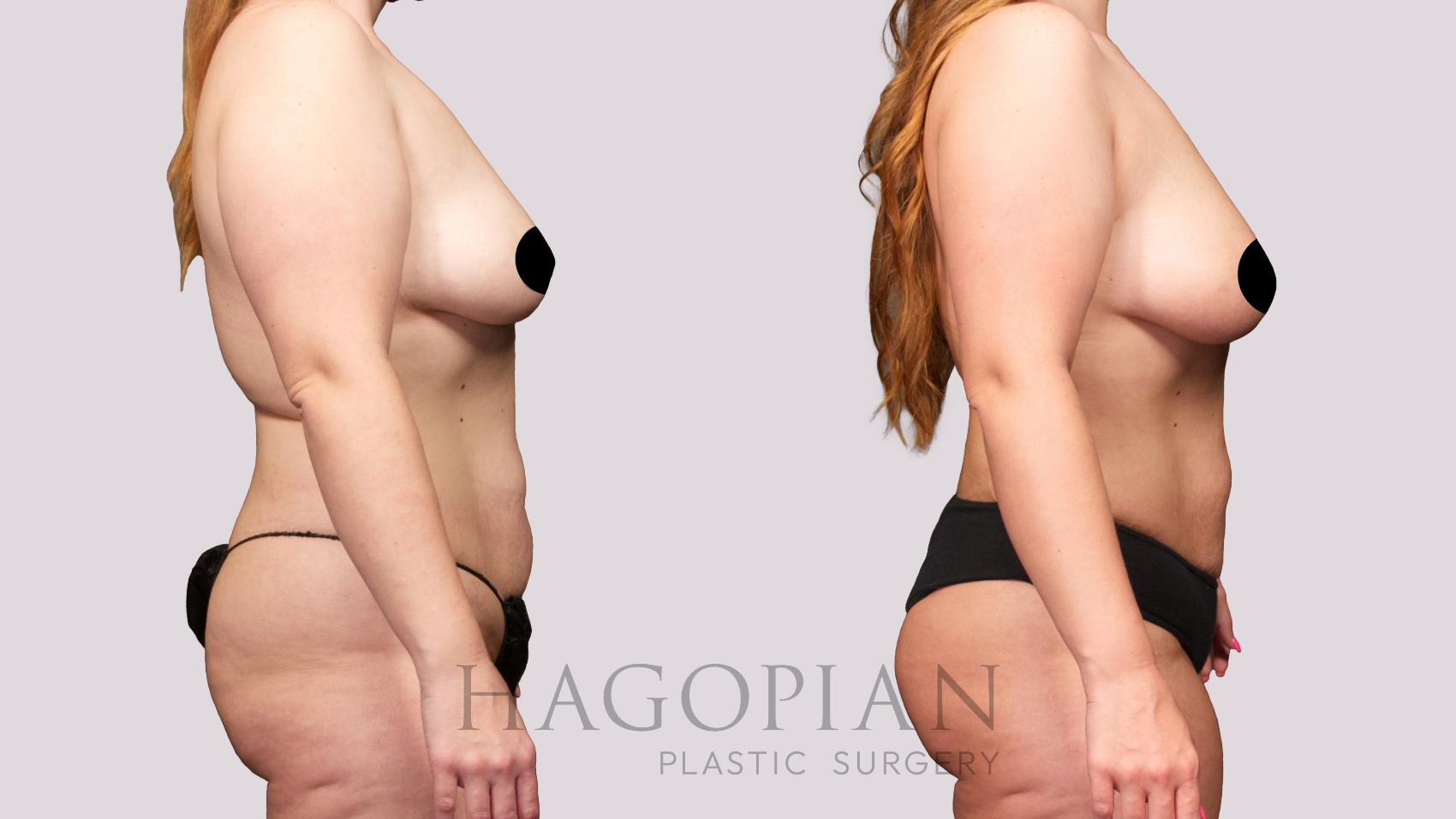 Before & After Brazilian Butt Lift Case 28 Right Side View in Atlanta, GA