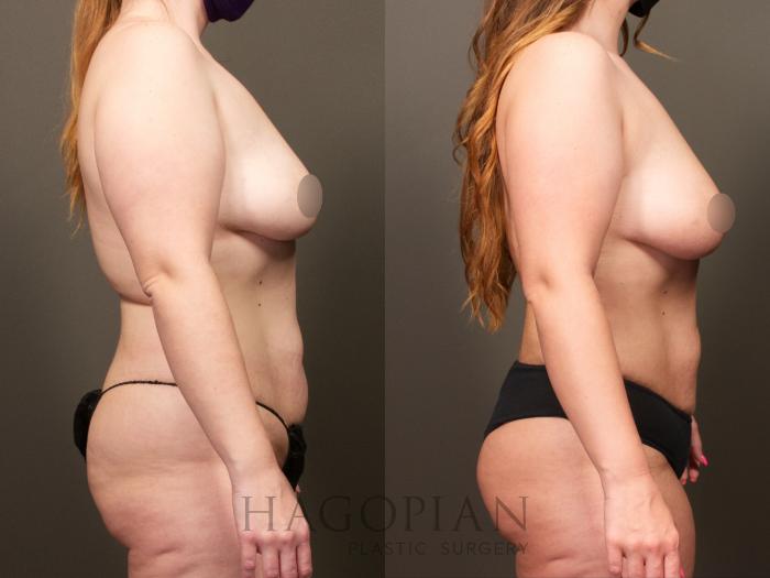 Before & After Brazilian Butt Lift Case 28 Right Side View in Atlanta, GA