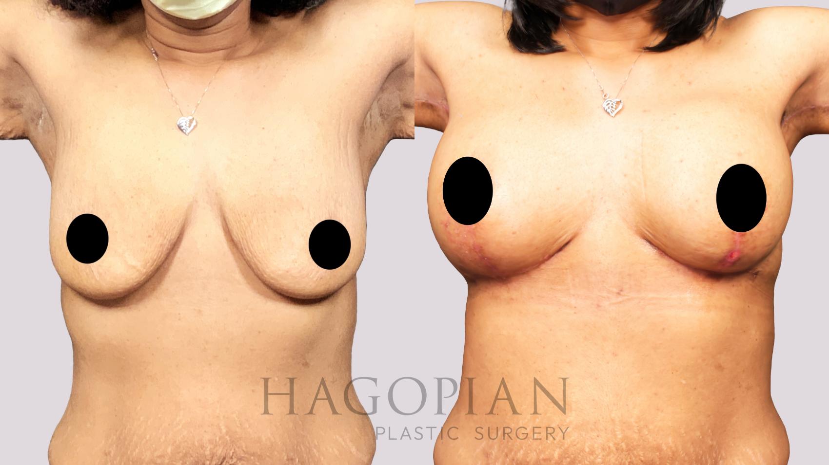 Before & After Breast Augmentation Case 205 Front View in Atlanta, GA