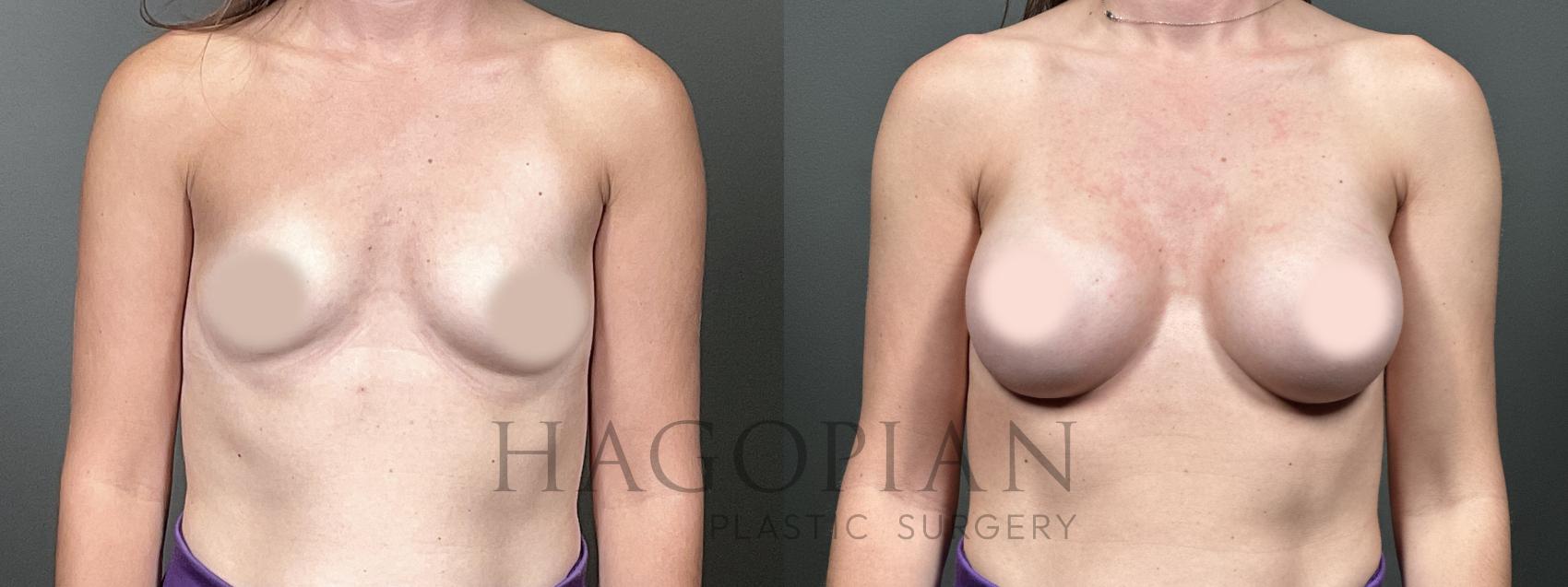 Before & After Breast Augmentation Case 50 Front View in Atlanta, GA