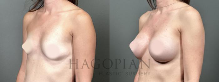 Before & After Breast Augmentation Case 50 Left Oblique View in Atlanta, GA