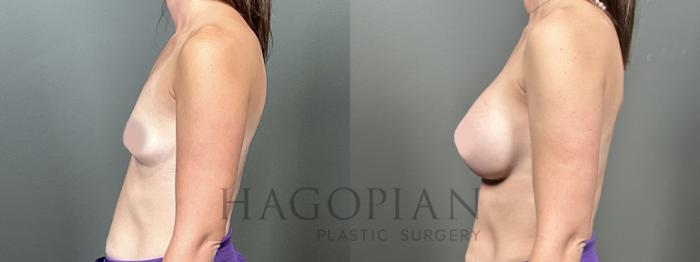 Before & After Breast Augmentation Case 50 Left Side View in Atlanta, GA