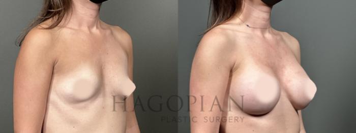Before & After Breast Augmentation Case 50 Right Oblique View in Atlanta, GA