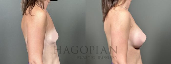 Before & After Breast Augmentation Case 50 Right Side View in Atlanta, GA