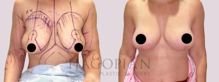 Before & After Breast Lift Case 170 Front View in Atlanta, GA