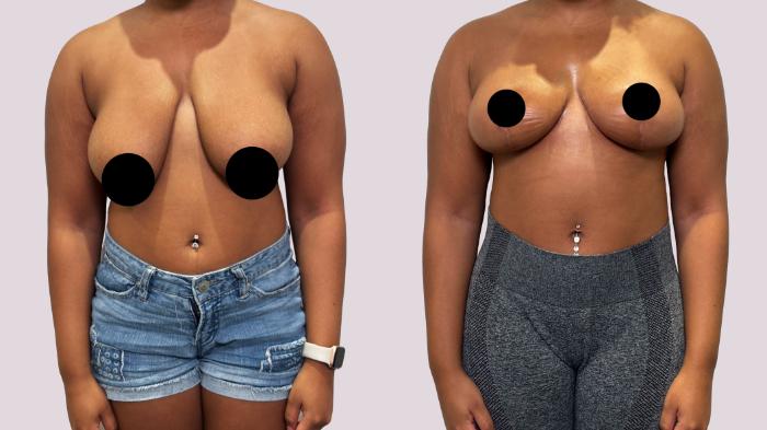 Before & After Breast Lift Case 180 Front View in Atlanta, GA