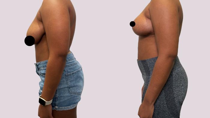 Before & After Breast Lift Case 180 Left Side View in Atlanta, GA