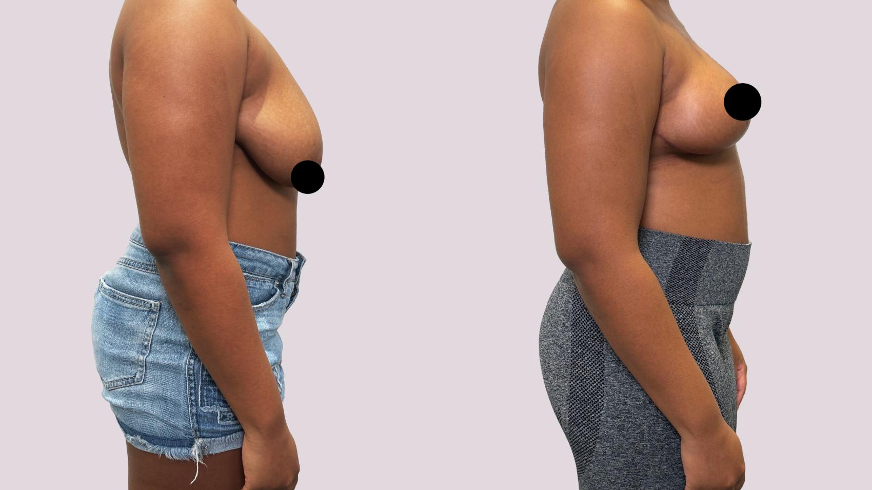 Before & After Breast Lift Case 180 Right Side View in Atlanta, GA