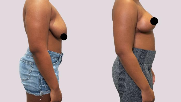 Before & After Breast Lift Case 180 Right Side View in Atlanta, GA