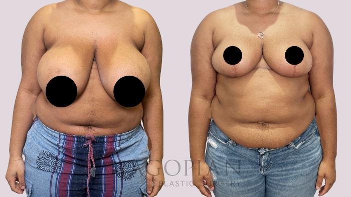 Before & After Breast Lift Case 184 Front View in Atlanta, GA