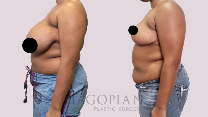 Before & After Breast Lift Case 184 Left Side View in Atlanta, GA