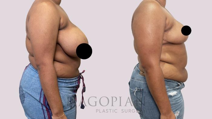 Before & After Breast Lift Case 184 Right Side View in Atlanta, GA