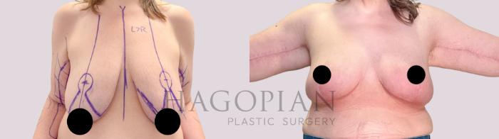 Before & After Breast Lift Case 240 Front View in Atlanta, GA