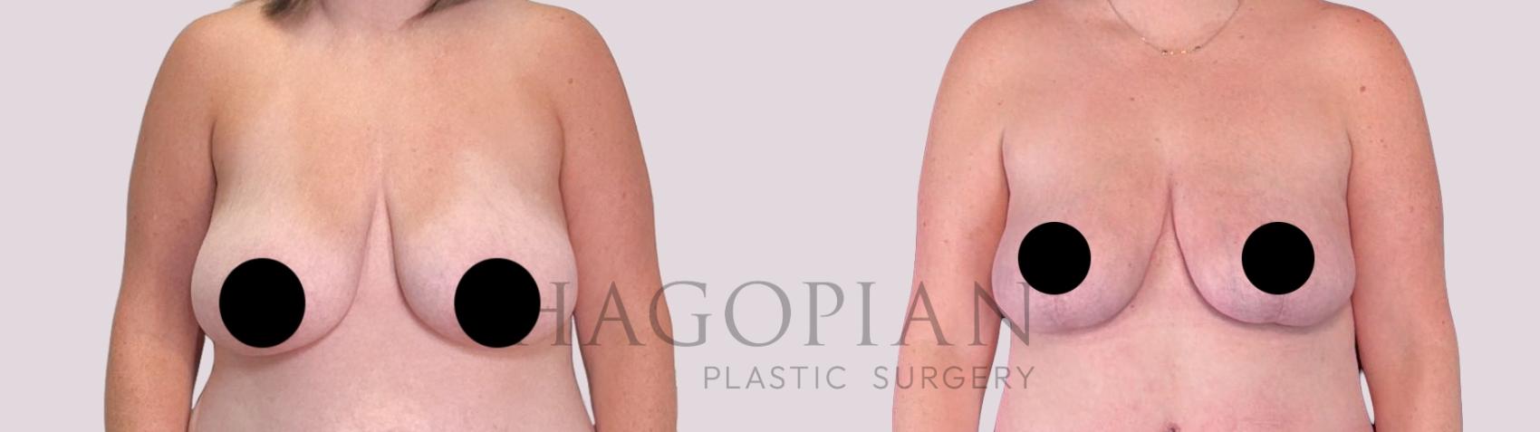 Before & After Breast Lift Case 256 Front View in Atlanta, GA