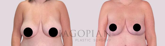 Before & After Breast Lift Case 256 Front View in Atlanta, GA