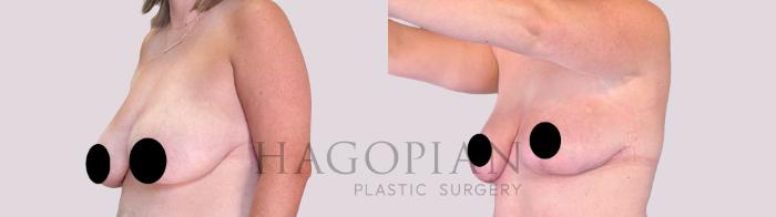 Before & After Breast Lift Case 256 Left Oblique View in Atlanta, GA