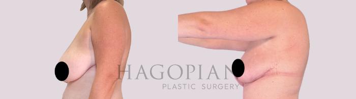 Before & After Breast Lift Case 256 Left Side View in Atlanta, GA