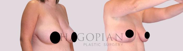 Before & After Breast Lift Case 256 Right Oblique View in Atlanta, GA